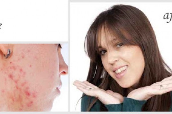 Acne And Vitamin B5 (Pantothenic Acid) Deficiency