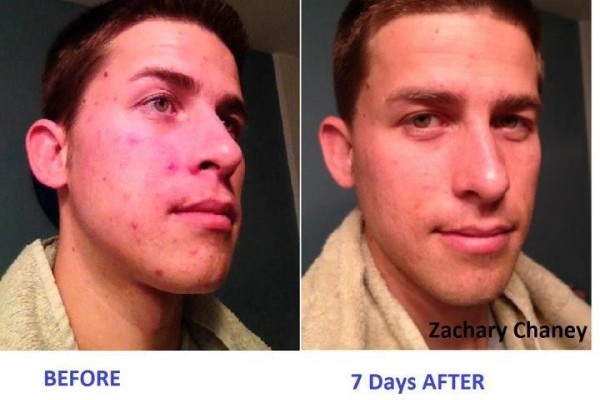 Acne And Vitamin B5 (Pantothenic Acid) Deficiency